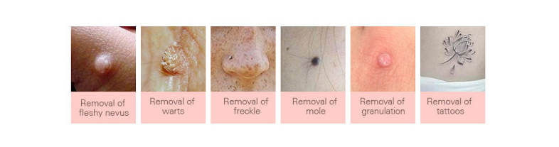 Mole Freckle Removal Pen Beauty Care Tool