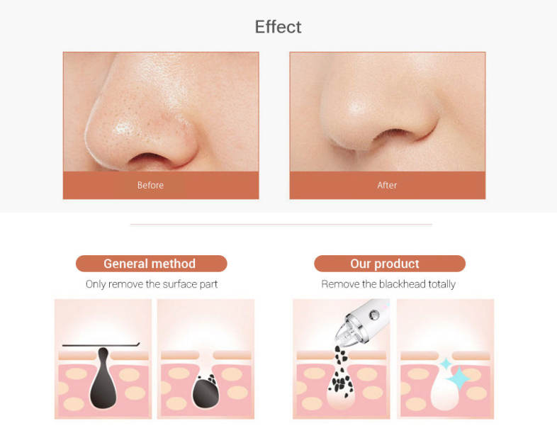 Kemei KM - 1871 7 in 1 Blackhead Vacuum Cleaner Beauty Suction Acne Removal Face Care